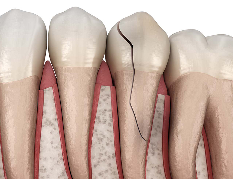 東京の歯医者、高輪歯科の睡眠歯科医療サービス、オーラルスリープ™の睡眠時ブラキシズム（歯ぎしり）