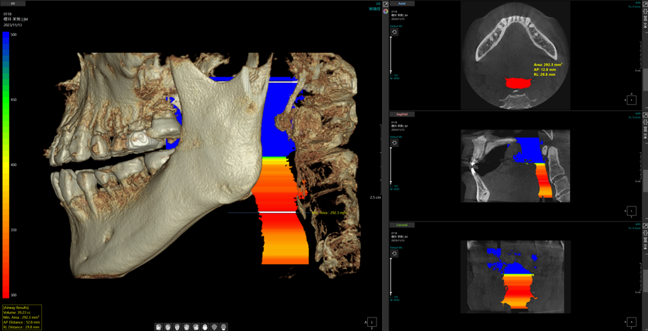 東京の歯医者、高輪歯科の睡眠歯科医療サービス、オーラルスリープ™で、マウスピース療法について解説