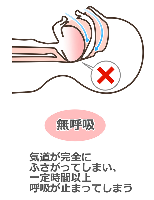 東京の歯医者、高輪歯科の睡眠歯科医療サービス、オーラルスリープ™で、いびきの種類と対策について解説