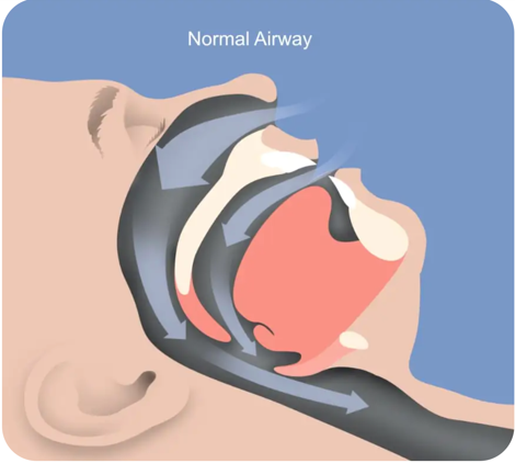 港区高輪の歯医者、高輪歯科の睡眠歯科医療サービス、オーラルスリープ™で、睡眠時無呼吸について解説