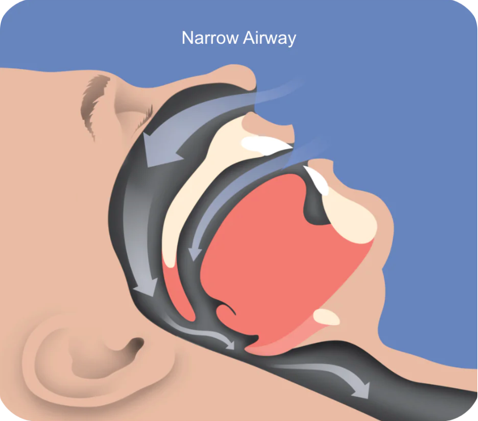 港区高輪の歯医者、高輪歯科の睡眠歯科医療サービス、オーラルスリープ™で、睡眠時無呼吸について解説