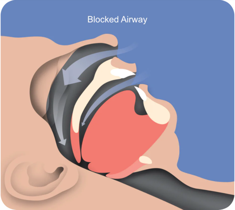 港区高輪の歯医者、高輪歯科の睡眠歯科医療サービス、オーラルスリープ™で、睡眠時無呼吸について解説